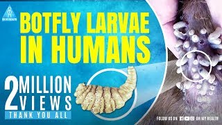 botfly larvae in humans [upl. by Hsekar]