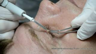 Soft fibroma  removal by highfrequency electrosurgery [upl. by Mohn]