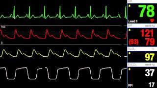 Normal Sinus Rhythm [upl. by Papke]