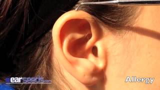 Allergy Auriculotherapy Ear Point [upl. by Suoirtemed]