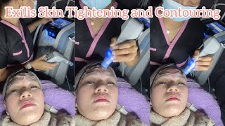 Exilis Skin Tightening and Contouring  Non Invasive Treatment [upl. by Britta]