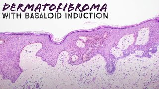 Dermatofibroma with basaloid follicular induction pathology mimic of basal cell carcinoma dermpath [upl. by Snapp]