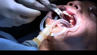 Submental Orotracheal Intubation in Severe Facial Trauma [upl. by Aivatahs410]