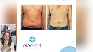 CoolSculpting Before and After Results  Element Body Lab  Dallas Texas [upl. by Ten]