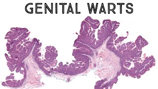 Genital warts under microscope condyloma acuminatum HPV pathology dermpath dermatology [upl. by Hunter274]