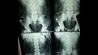 IVPIVU Intravenous UrographyPyelography BASICS OF RADIOGRAPH EXPLAINED [upl. by Brownley861]