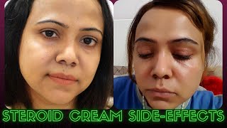 Treatment of Steroid Cream Side Effects and How To Bring back you original Skin Tone [upl. by Ekaterina]