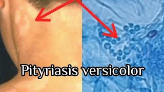 Pityriasis Versicolor under the microscope [upl. by Rhyne774]