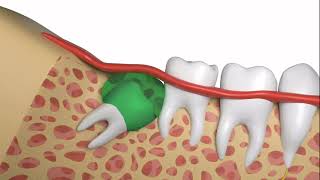 How To Safely and Quickly Have a Wisdom Tooth Extraction [upl. by Maryjane]