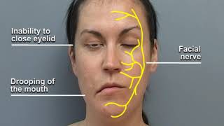 Understanding Facial Palsy [upl. by Ynnhoj768]