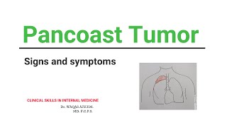 Pancoast tumor Signs and symptoms and treatment [upl. by Amrita]