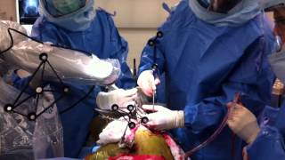 Total Hip Replacement Using MAKO Robotic Assistance [upl. by Kauffmann]