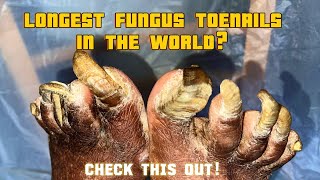 Extremely fungal thickened toenails I Onychogryphosis Transformation Trust Your Podiatrist [upl. by Philipson]