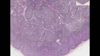 Histopathology Lymph node  Follicular hyperplasia [upl. by Aneles]