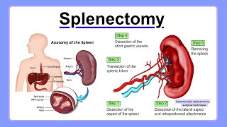 splenectomy [upl. by Yadnil]