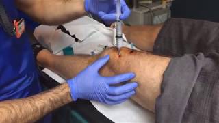 LIVE Precision Pain Medicine Ribi Demonstrates a Knee Genicular Block [upl. by Pincince]