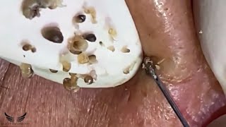 Cystic Acne Blackhead Removal  Elderly Hidden Acne Treatment  Pimple Popping Spa Extraction  060 [upl. by Tijnar]