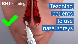 Teaching patients to use nasal sprays  BMJ Learning [upl. by Sicular]