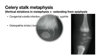 Radiology Spotter  vegetable sign  celery stalk metaphysis [upl. by Flodnar]