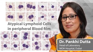 Commonly seen and not so commonly seen Atypical Lymphoid in the peripheral blood  Dr Pankhi Dutta [upl. by Jakoba]