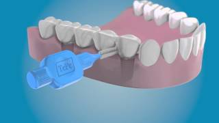 Limpie los laterales de sus implantes con un cepillo interdental TePe [upl. by Derf]