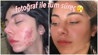 Fotoğraflı Roaccutane Sürecim🥵🧖🏻‍♀️ Sivilce Tedavisi✨ [upl. by Ajssatsan]