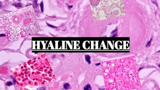 HYALINE CHANGE  FUNDAMENTALS WITH EXAMPLES [upl. by Letisha123]