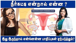 PCOD இருந்தால் கர்ப்பப்பையில் என்னென்ன பிரச்சினைகள் வரும்   Dr BYoga Vidhya pcos pcod female [upl. by Enitsirhk]