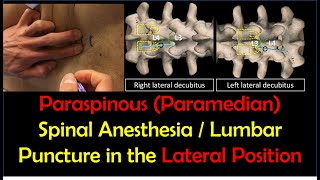 quotHowToquot Guide  Paraspinous Lumbar Puncture  Spinal Anesthesia Lateral Position [upl. by Diraf]