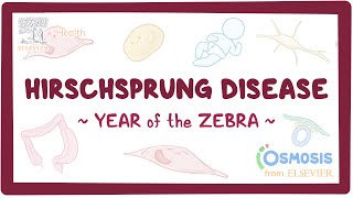 Hirschsprung disease Year of the Zebra [upl. by Carly596]