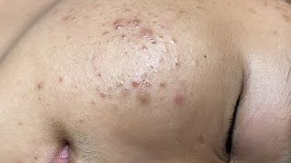 ACNE TREATMENT VU QUYNH MI Acne On Boys Chin 2024 [upl. by Sibelle]