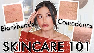 The TRUTH About Blackheads Comedones amp Congested Skin 👏🏻 ✨ Treatment and Prevention [upl. by Eneja]