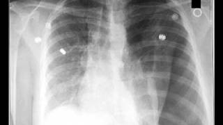 Diagnosis and Treatment of Tension Pneumothorax [upl. by Ettelimay]