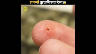 Splinter को तुरंत निकाल देना 😰  Remove Splinter Immediately  The Fact  shorts ytshorts [upl. by Chita682]