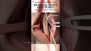 Innovative Treatment for Humerus Fracture medical shorts tech suture science animation learn [upl. by Areivax]