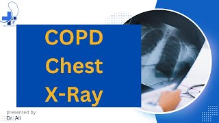 COPD X Ray Findings Chronic Obstructive Pulmonary Disease XRay [upl. by Georgette]