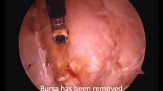 Arthroscopic Hip Bursectomy and Illiotibial Band Release [upl. by Noira]