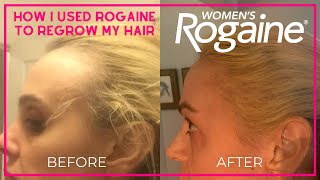 Rogaine for Women Before and After [upl. by Kristopher]