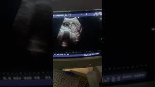 Cystic hygroma in 20 weeks baby boy Baby boy Gender prediction Radiology vibes [upl. by Arnulfo]