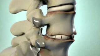 Degenerative Disc Disease  DePuy Videos [upl. by Bakeman973]