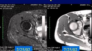 MRI of Soft Tissue Tumors  Pt1 [upl. by Ladonna802]