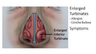 Enlarged Nasal Turbinates Symptoms and Treatment [upl. by Jemy501]