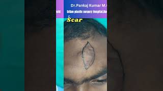 Scar revision surgeryScar treatment in Ranchi Shorts scar [upl. by Bish]