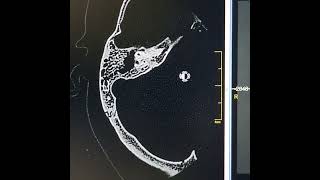 Right mastoiditis and suppurative otitis media [upl. by Merrel938]