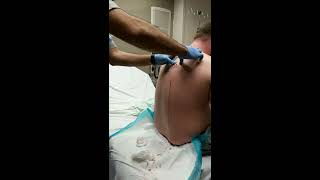 Large cyst Bursts out mans back Viewer beware [upl. by Arondel]