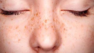 Freckles  Agespots LaserTreatment [upl. by Nosnarb123]