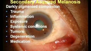 Pigmented Conjunctival Lesions When Should I Be Concerned [upl. by Aiekal]