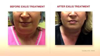 Exilis Elite Face Treatment Amara Clinic [upl. by Lightfoot]