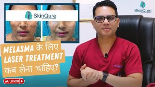 Best Treatment for Melasma  Laser Treatment for Melasma in Delhi  SkinQure  Dr Jangid [upl. by Suravaj]