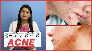 Acne Reason on Face  Acne Treatment [upl. by Kimmy]